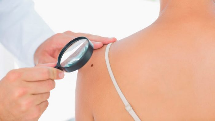 Cerca de 350 personas mueren cada año en Chile por cáncer de piel Cerca de 350 personas mueren cada año en Chile por cáncer de piel