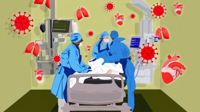 De enfermedad respiratoria a multisistémica: cómo en pocas semanas cambió radicalmente lo que sabemos sobre la covid-19 De enfermedad respiratoria a multisistémica: cómo en pocas semanas cambió radicalmente lo que sabemos sobre la covid-19
