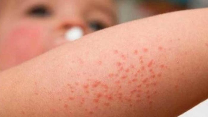 Día Internacional de la Dermatitis Atópica: una enfermedad poco conocida que afecta a miles de personas en Chile Día Internacional de la Dermatitis Atópica: una enfermedad poco conocida que afecta a miles de personas en Chile