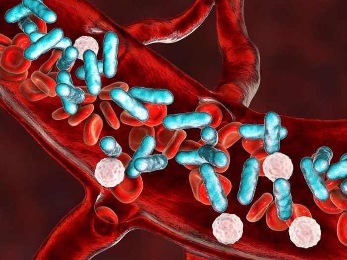 Sepsis: la emergencia sanitaria que puede ocasionar la muerte de quien la padece Sepsis: la emergencia sanitaria que puede ocasionar la muerte de quien la padece
