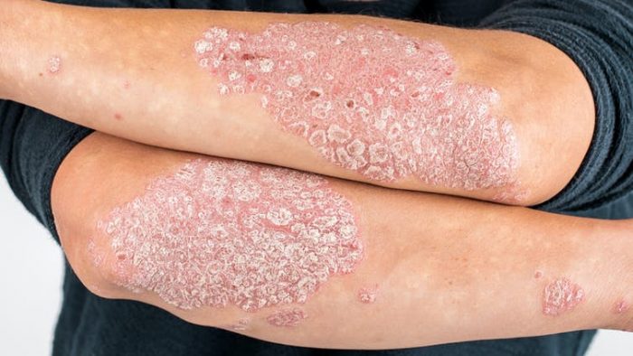 Psoriasis: la solución está en el sistema inmunitario Psoriasis: la solución está en el sistema inmunitario