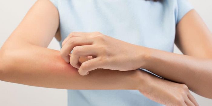 Expertos advierten necesidad diagnosticar y tratar la urticaria para evitar deterioro en calidad de vida del afectado Expertos advierten necesidad diagnosticar y tratar la urticaria para evitar deterioro en calidad de vida del afectado