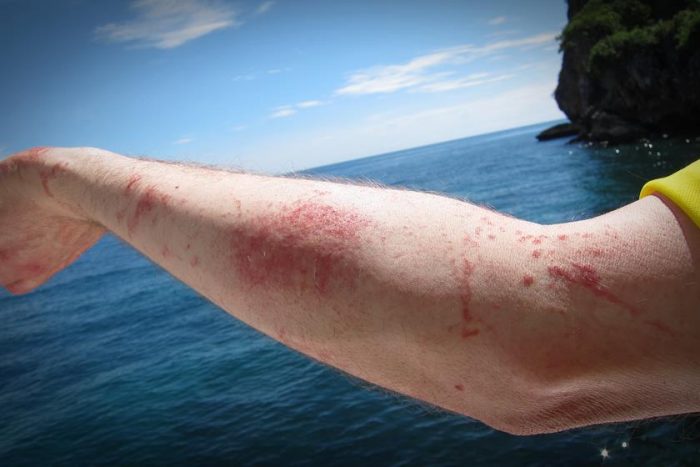 Psoriasis: la enfermedad que complica a quienes la padecen en el verano Psoriasis: la enfermedad que complica a quienes la padecen en el verano