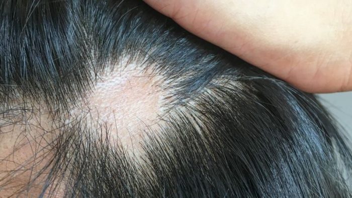Coronavirus: qué causa y cómo tratar la caída del cabello que afecta a uno de cada cuatro infectados Coronavirus: qué causa y cómo tratar la caída del cabello que afecta a uno de cada cuatro infectados
