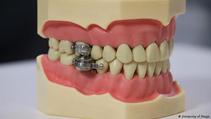 Para combatir la obesidad: dispositivo evita que la boca se abra más de 2 milímetros