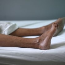 Síndrome de Guillain-Barré: el trastorno neurológico que afecta a algunas personas vacunadas contra el coronavirus