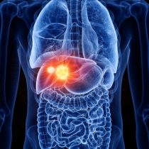 ¿Cómo saber qué personas con hígado graso tienen mayor riesgo de padecer cáncer hepático?