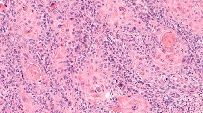 ¿Tener el virus del papiloma humano significa enfermar de cáncer? ¿Tener el virus del papiloma humano significa enfermar de cáncer?