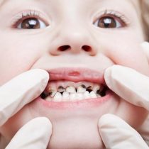 Demencia y ataques cardíacos: dientes en mal estado pueden producir graves enfermedades