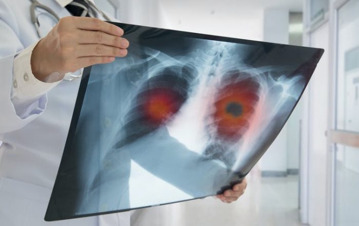 Estrategias para atacar el metabolismo del cáncer desde su base Estrategias para atacar el metabolismo del cáncer desde su base