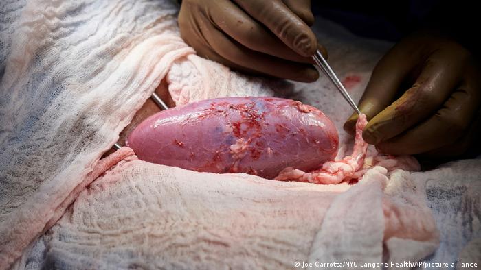Cirujanos estadounidenses consiguen trasplantar a un paciente un corazón de cerdo