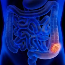 Cáncer de colon: más de 500 personas son diagnosticas cada mes y es el segundo más frecuente en Chile