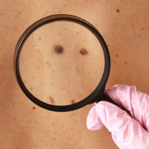 El sencillo autoexamen que puede ayudarte a prevenir el cáncer de piel