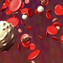 Leucemia: cómo es el cáncer que comúnmente se confunde con otras patologías
