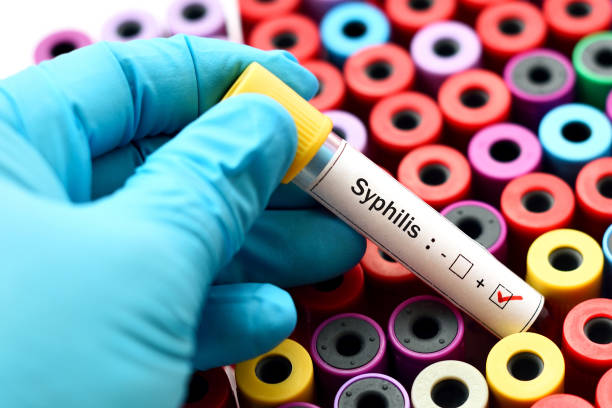 Mitos sobre el sífilis: ¿cómo prevenir esta ITS?